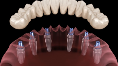 Dental İmplant Tedavisi