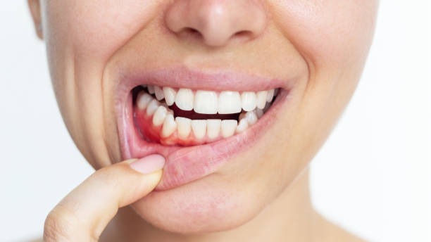 Periodental Bakımı (Diş Eti Kanaması)