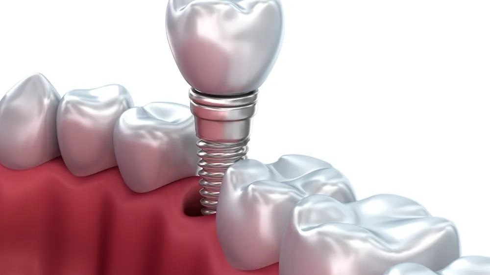 İmplantoloji (Dental İmplant)